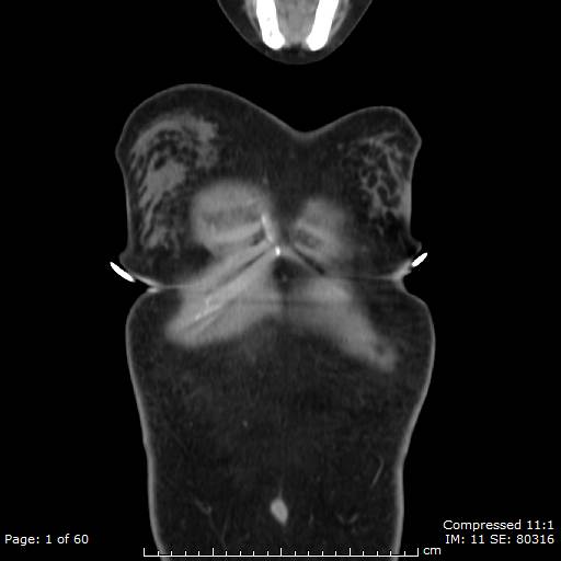File:Anterior mediastinal B cell Lymphoma (Radiopaedia 50677-56114 B 1).jpg