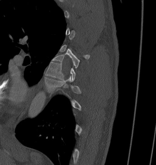 Anterior shoulder dislocation with Hill-Sachs and bony Bankart lesions (Radiopaedia 40424-42974 Sagittal bone window 80).png