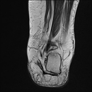 File:Anterior talofibular ligament injury - rupture with soft-tissue impingement (Radiopaedia 38765-40928 Coronal T2 9).jpg