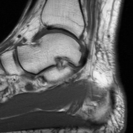File:Anterior talofibular ligament rupture (Radiopaedia 15831-15484 Sagittal T1 13).jpg