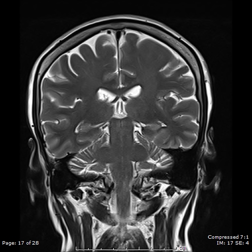 File:Anterior temporal lobe perivascular space (Radiopaedia 88283-104914 Coronal T2 17).jpg