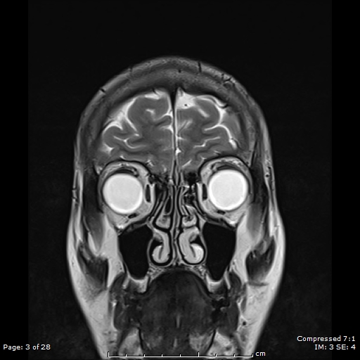 File:Anterior temporal lobe perivascular space (Radiopaedia 88283-104914 Coronal T2 3).jpg