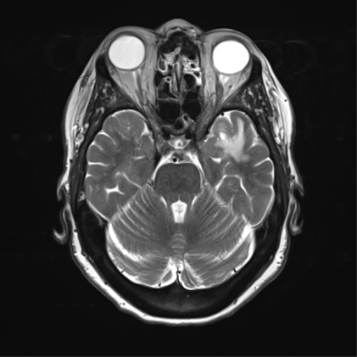 File:Anterior temporal pole cysts (Radiopaedia 46629-51102 C 13).png