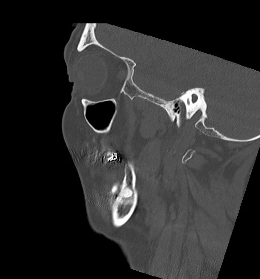 Anterior temporomandibular joint dislocation (Radiopaedia 59430-66784 B 48).jpg