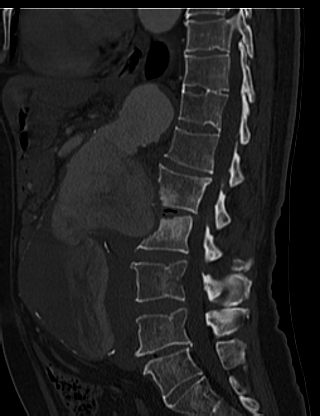 File:Anterior vertebral scalloping (abdominal aortic aneurysm) (Radiopaedia 66744-76067 Sagittal bone window 42).jpg