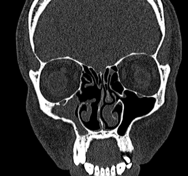 File:Antrochoanal polyp (Radiopaedia 30002-30554 Coronal bone window 31).jpg