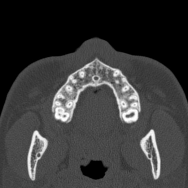 Antrochoanal polyp (Radiopaedia 33984-35202 Axial bone window 1).jpg