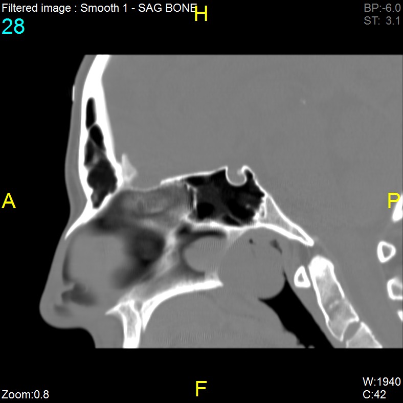 Antrochoanal polyp (Radiopaedia 65101-74094 Sagittal bone window 28).jpg