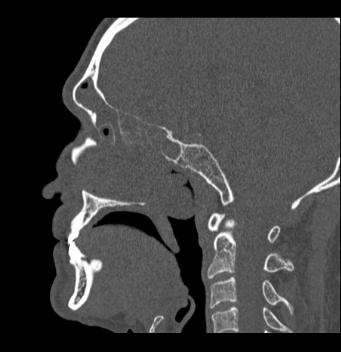 Antrochoanal polyp (Radiopaedia 79011-92169 Sagittal bone window 22).jpg