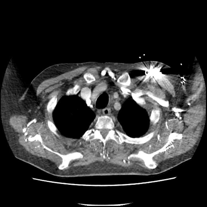 Aortic arch graft infection (FDG PET-CT) (Radiopaedia 71975-82437 A 6).jpg