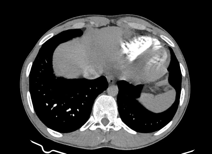 File:Aortic coarctation with aneurysm (Radiopaedia 74818-85828 A 55).jpg