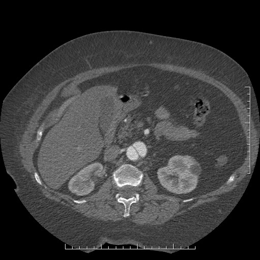 Aortic dissection- Stanford A (Radiopaedia 35729-37268 B 59).jpg