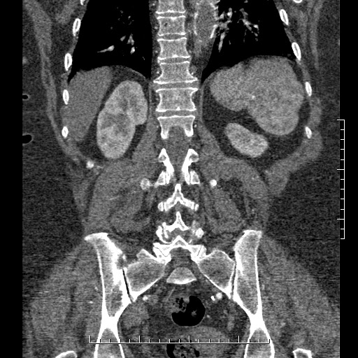 Aortic dissection- Stanford A (Radiopaedia 35729-37268 F 5).jpg