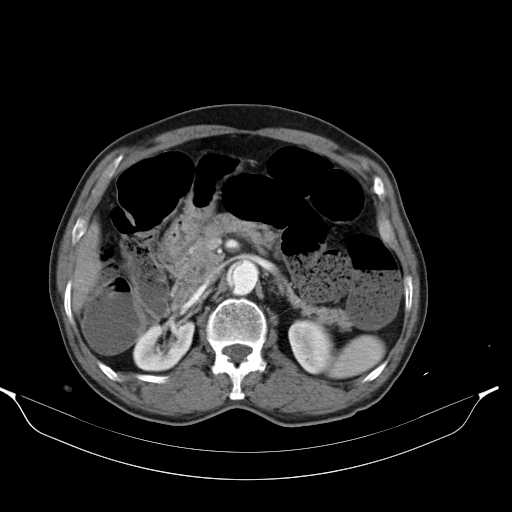 Aortic dissection- Stanford type A (Radiopaedia 22085-22085 A 45).jpg