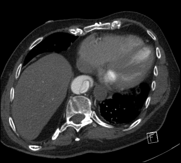 File:Aortic dissection (CTPA) (Radiopaedia 75506-86750 A 71).jpg