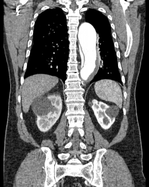 Aortic dissection (Radiopaedia 44411-48061 A 47).jpg