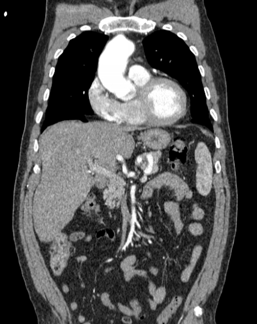 Aortic dissection (Radiopaedia 44411-48061 A 8).jpg