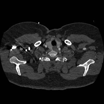 File:Aortic dissection (Radiopaedia 57969-64959 A 19).jpg