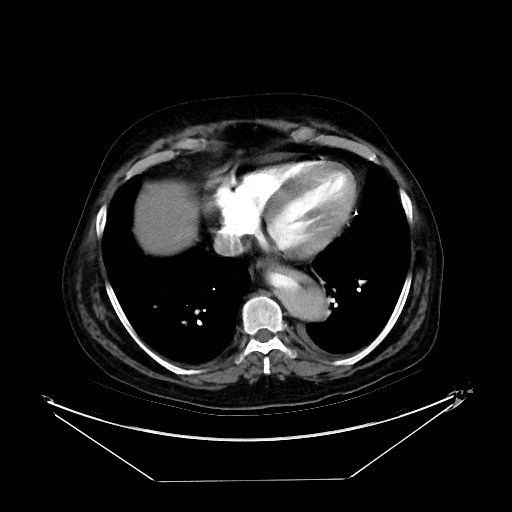 Aortic dissection (Radiopaedia 62562-71000 A 33).jpg