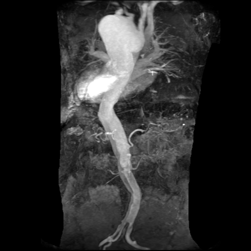 File:Aortic dissection - Stanford A - DeBakey I (Radiopaedia 23469-23551 MRA 13).jpg