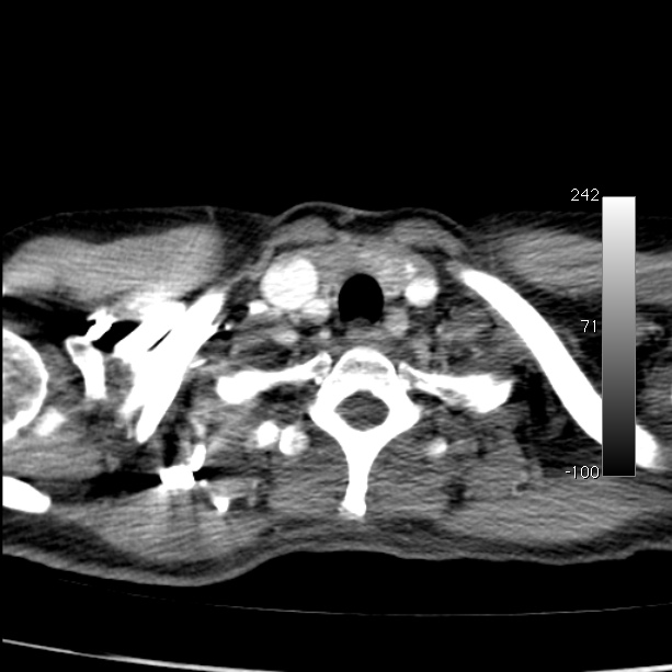 Aortic dissection - Stanford type A (Radiopaedia 29247-29659 A 7).jpg