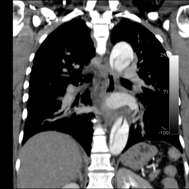 Aortic dissection - Stanford type A (Radiopaedia 29247-29659 B 39).jpg