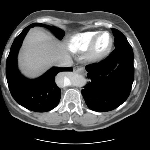 File:Aortic dissection - Stanford type B (Radiopaedia 50171-55512 A 40).png