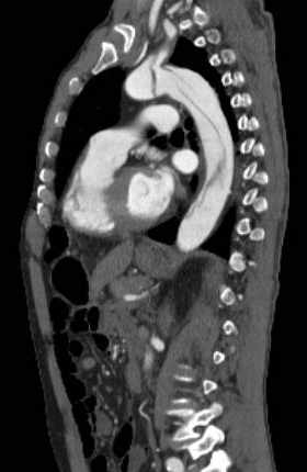 File:Aortic dissection - Stanford type B (Radiopaedia 73648-84437 C 63).jpg