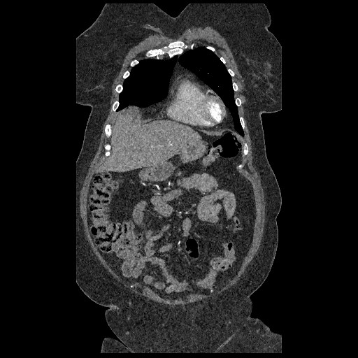 File:Aortic dissection - Stanford type B (Radiopaedia 88281-104910 B 10).jpg