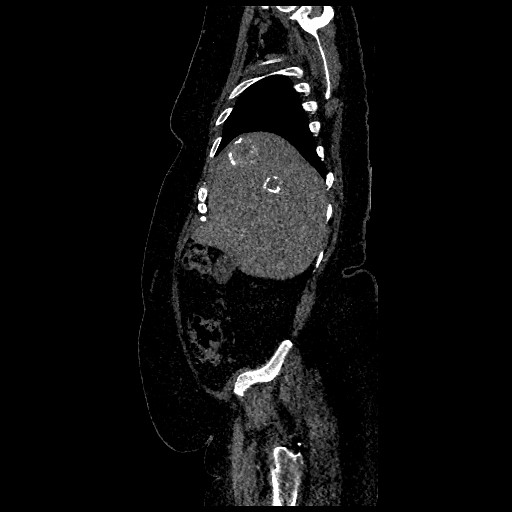 File:Aortic dissection - Stanford type B (Radiopaedia 88281-104910 C 11).jpg