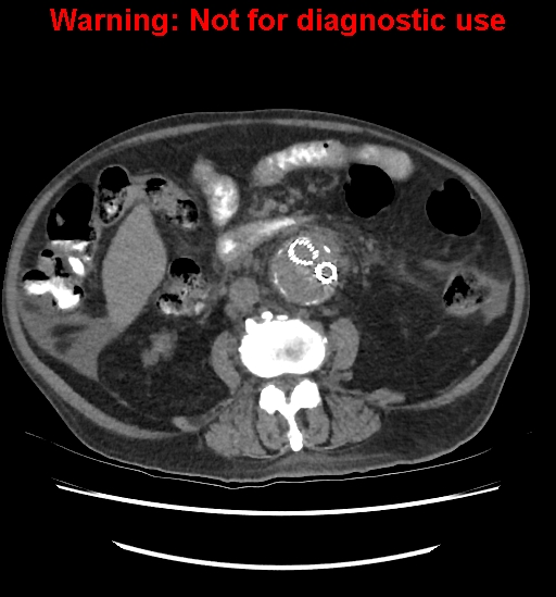 File:Aortic graft infection (Radiopaedia 44979-48907 Axial non-contrast 52).jpg