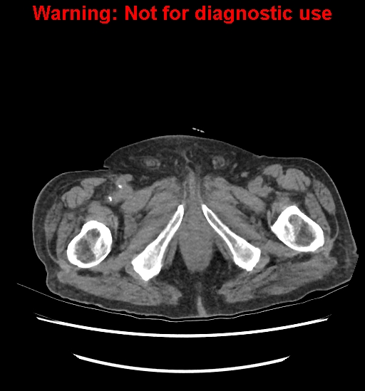 File:Aortic graft infection (Radiopaedia 44979-48907 Axial non-contrast 98).jpg