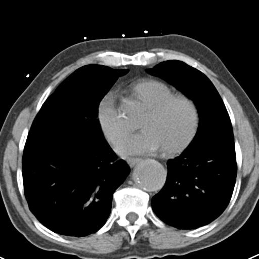 File:Aortic intramural hematoma (Radiopaedia 31139-31838 Axial non-contrast 36).jpg