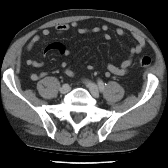 Aortic intramural hematoma (type B) (Radiopaedia 79323-92387 Axial C+ delayed 90).jpg