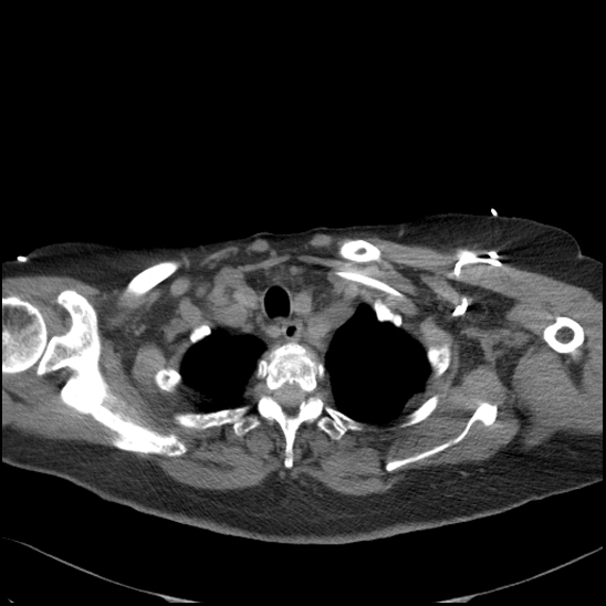 Aortic intramural hematoma with dissection and intramural blood pool (Radiopaedia 77373-89491 Axial non-contrast 17).jpg