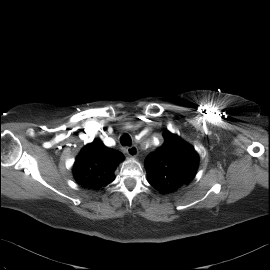 Aortic intramural hematoma with dissection and intramural blood pool (Radiopaedia 77373-89491 B 32).jpg