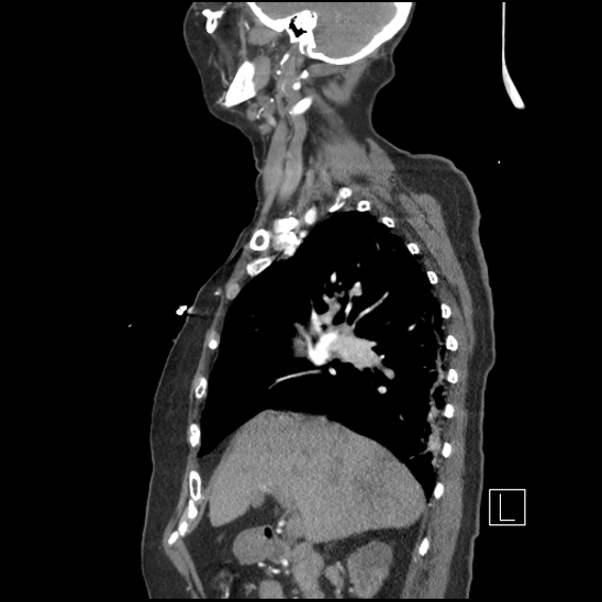 File:Aortic intramural hematoma with dissection and intramural blood pool (Radiopaedia 77373-89491 D 29).jpg