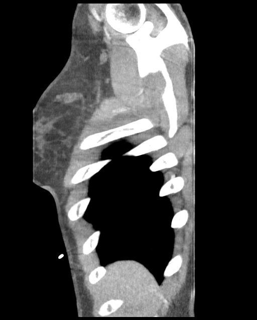 Aortic valve non-coronary cusp thrombus (Radiopaedia 55661-62189 D 49).png