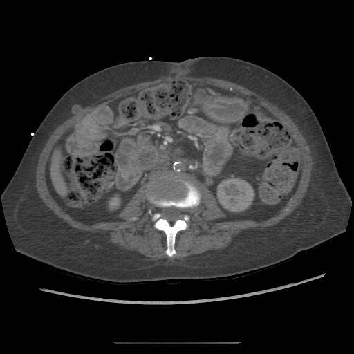 Aorto-duodenal fistula (Radiopaedia 25668-25850 A 42).jpg