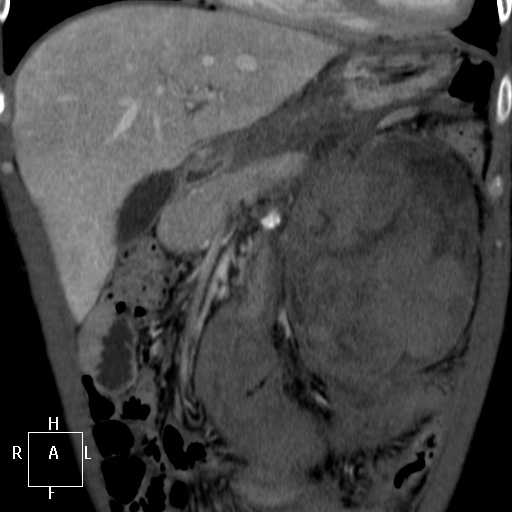 Aorto-left renal vein fistula (Radiopaedia 45534-49628 B 12).jpg