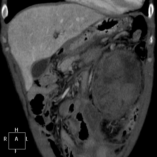 Aorto-left renal vein fistula (Radiopaedia 45534-49628 B 6).jpg