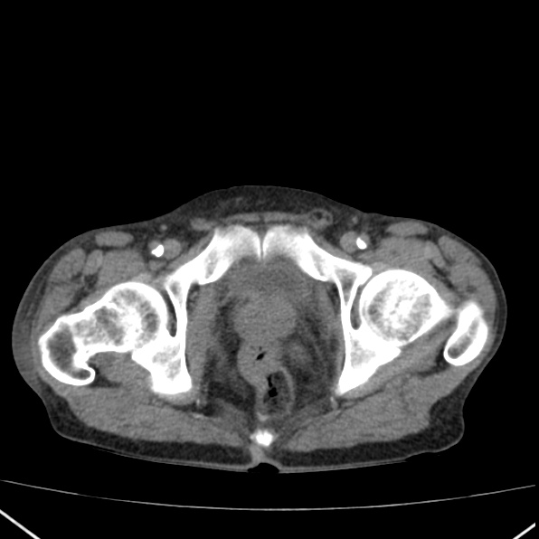 Aortoiliac occlusive disease (Radiopaedia 32134-33076 Axial non-contrast 52).jpg