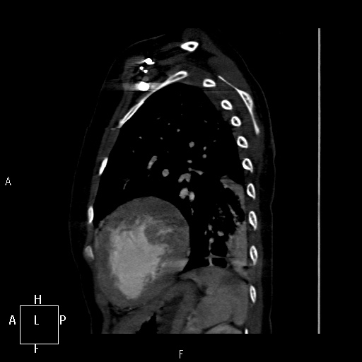 File:Aortopulmonary septal defect (Radiopaedia 41990-45013 Sagittal C+ CTPA 1).jpg