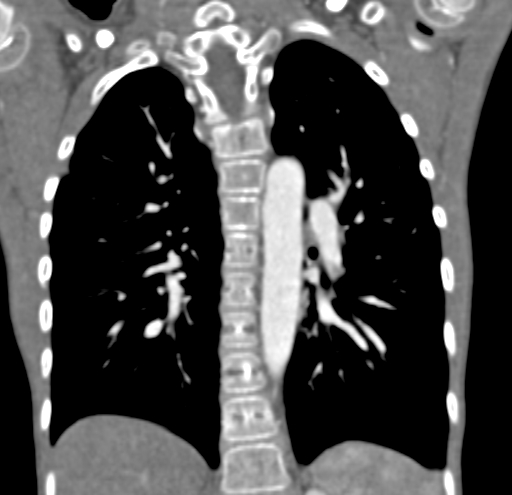File:Aortopulmonary window, interrupted aortic arch and large PDA giving the descending aorta (Radiopaedia 35573-37074 D 49).jpg