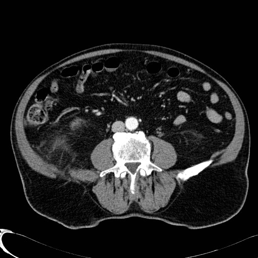 File:Appendiceal adenocarcinoma complicated by retroperitoneal abscess (Radiopaedia 58007-65039 B 79).jpg