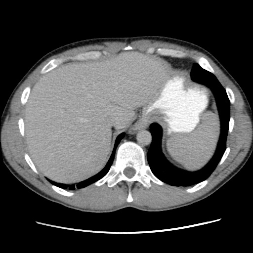 File:Appendicitis complicated by post-operative collection (Radiopaedia 35595-37114 A 16).jpg