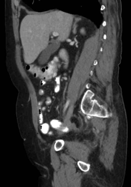 Appendicitis due to chicken fibula (Radiopaedia 74314-85198 C 36).jpg
