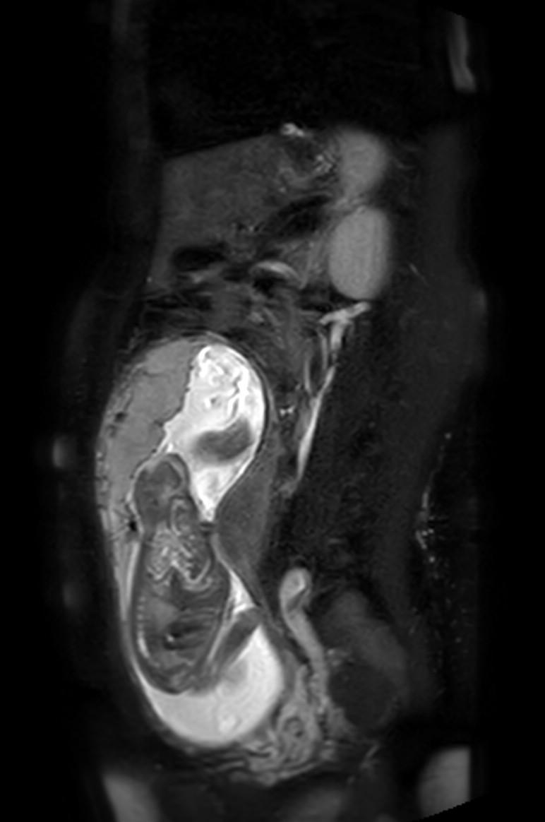 Appendicitis in gravida (MRI) (Radiopaedia 89433-106395 Sagittal T2 SPAIR 25).jpg