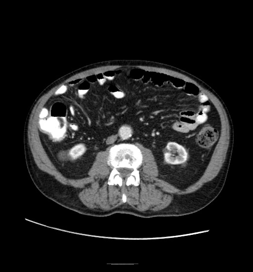 Appendicitis with localized perforation and abscess formation (Radiopaedia 49035-54130 A 48).jpg
