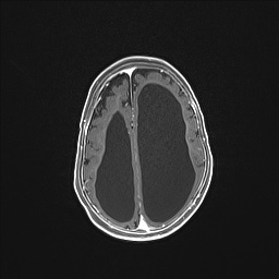 Aqueductal stenosis (Radiopaedia 73974-84802 Axial T1 C+ 112).jpg